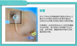 输液港维护视频,轻松掌握输液港日常维护技巧